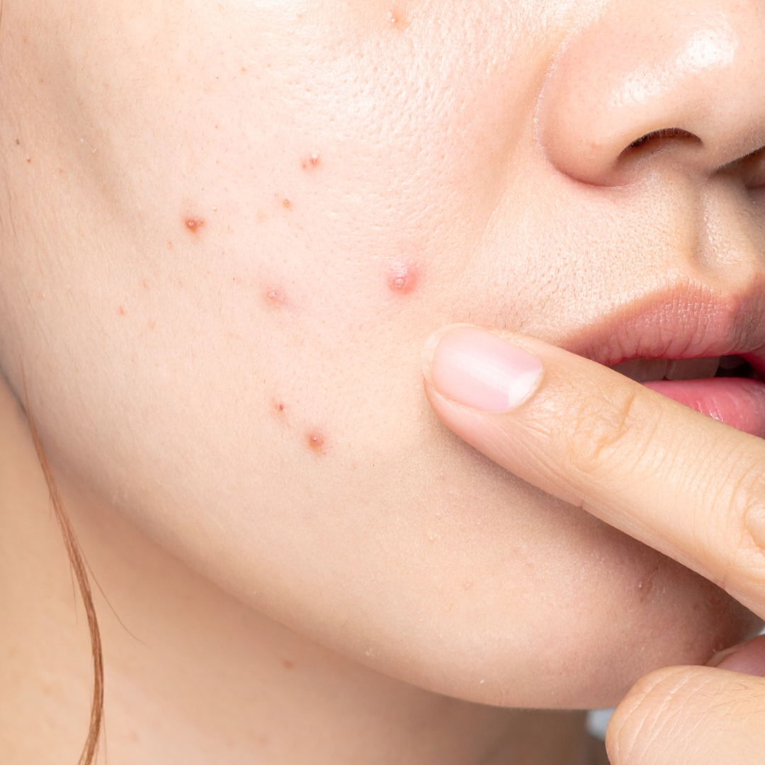 Acne & Blemishes solutions